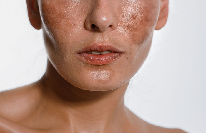 Close-up of hyperpigmentation on a woman's face