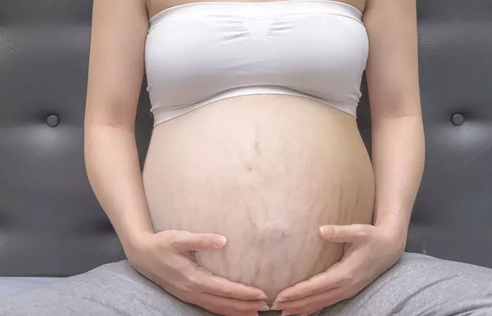 Close up of stretch marks on a pregnant woman