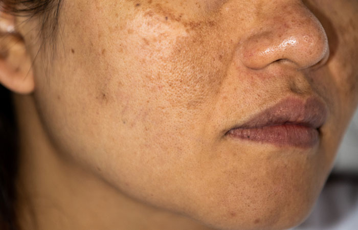 Closeup of hyperpigmentation and discoloration
