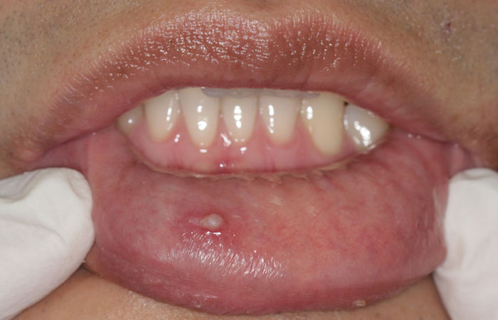 Filiform warts seen on the inside of the lips