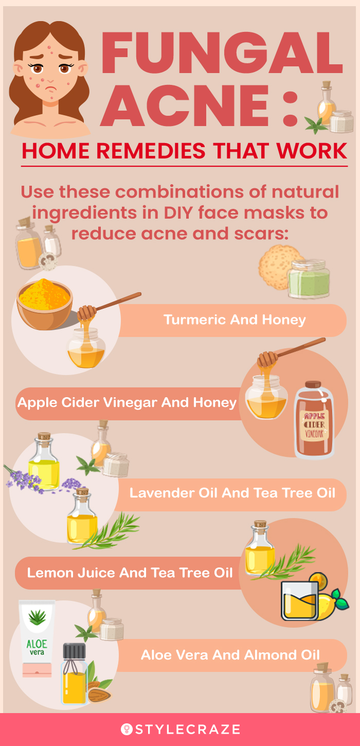 fungal acne remedies (infographic)