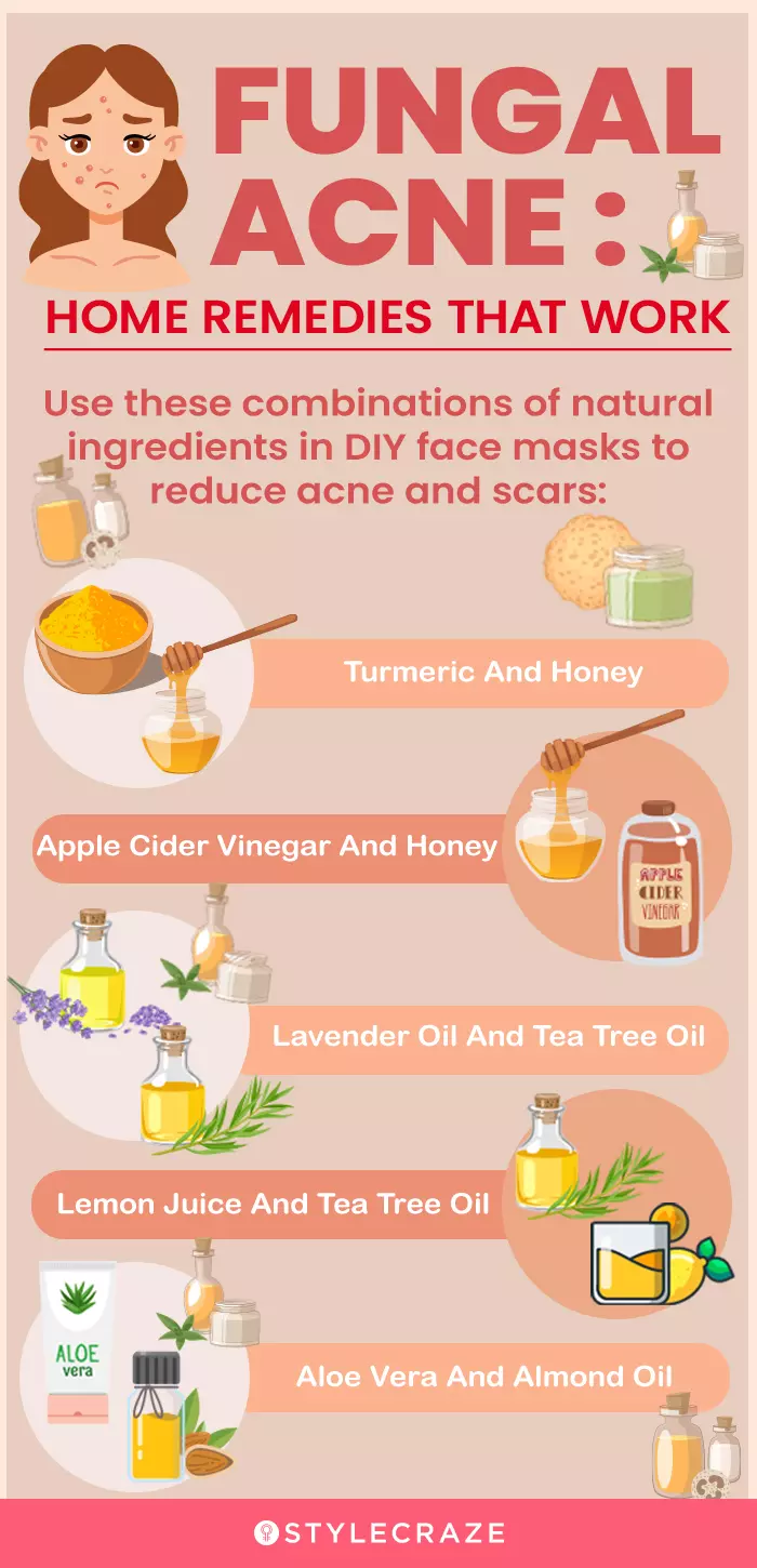 fungal acne remedies (infographic)