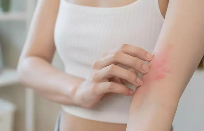 Hand of a woman with rashes