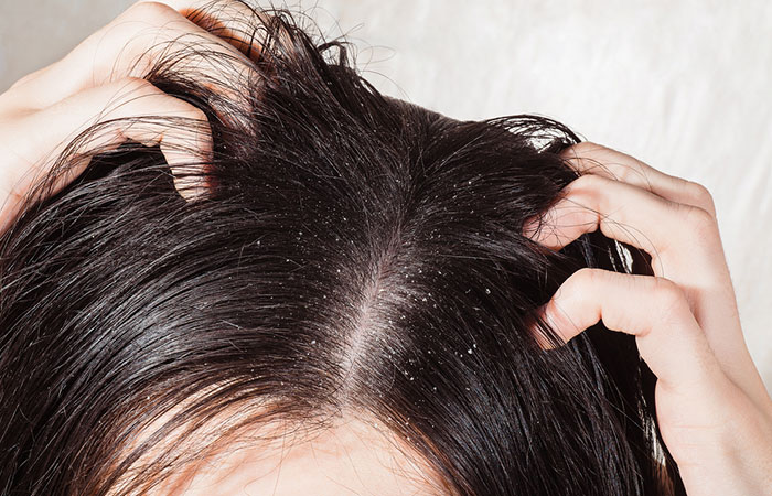 Itchy scalp with dandruff
