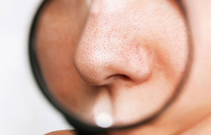 Magnified view of blackheads on the nose