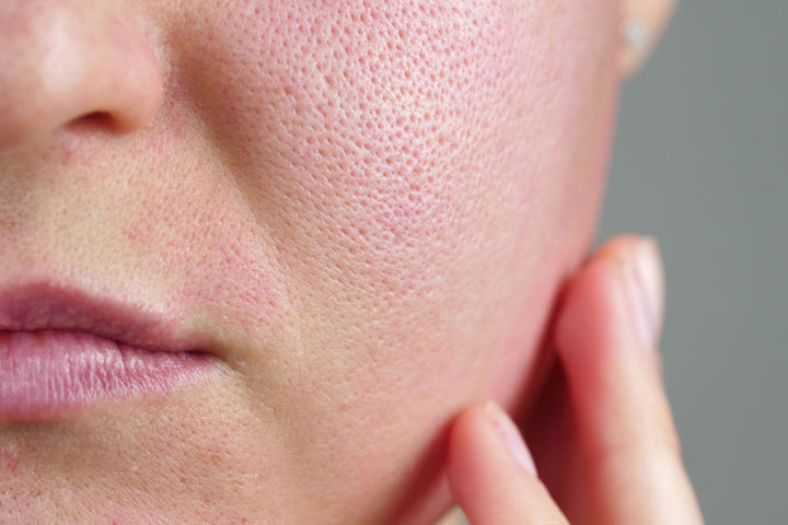 Multani mitti may benefit woman examining her enlarged pores 