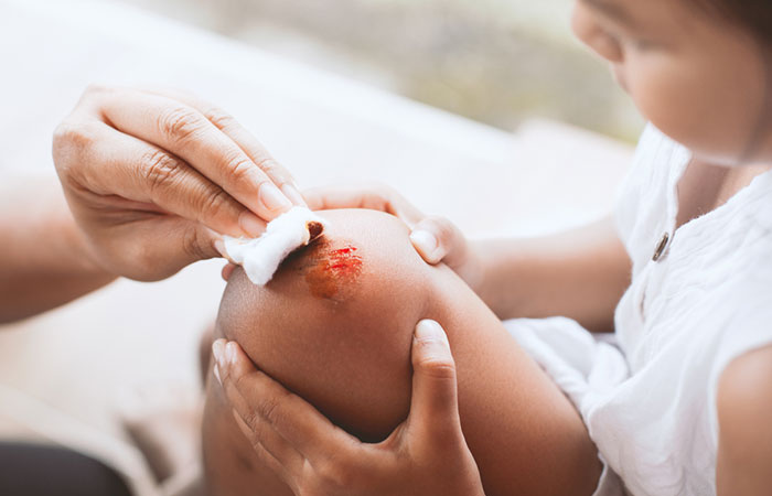 Parent applying asafoedita paste directly on the wound on the knee of the child to help soothe and treat it