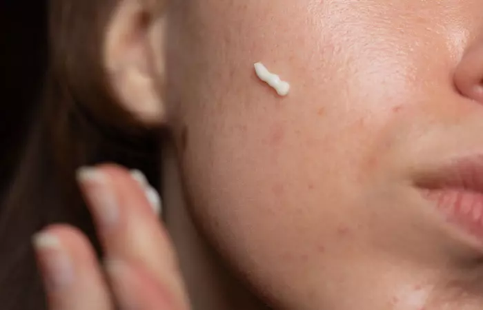 Woman applying prescription cream to get rid of hyperpigmentation