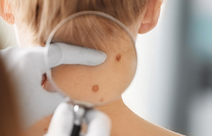 Woman consulting a dermatologist for skin spots
