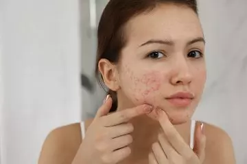 Woman dealing with acne breakouts
