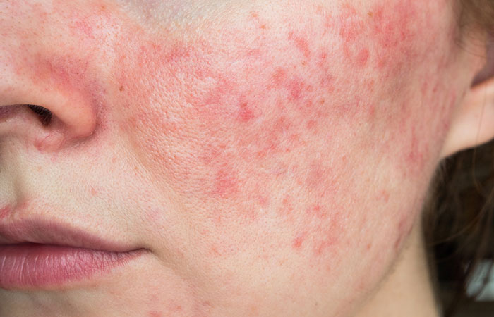 Woman dealing with rosacea