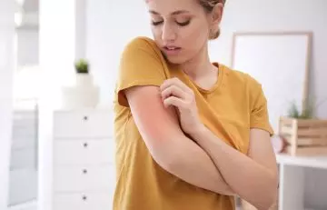 Woman scratching her skin allergy
