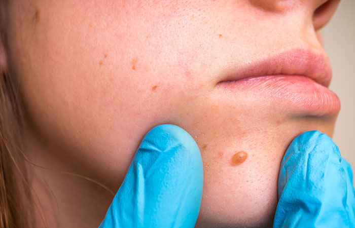 Woman with a skin tag near the mouth