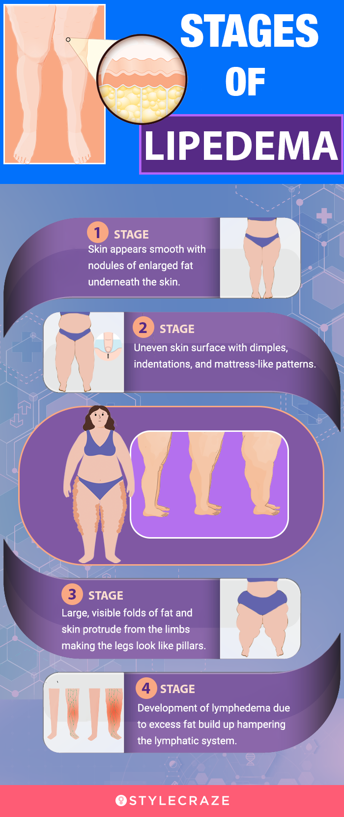 stages of lipidema (infographic)