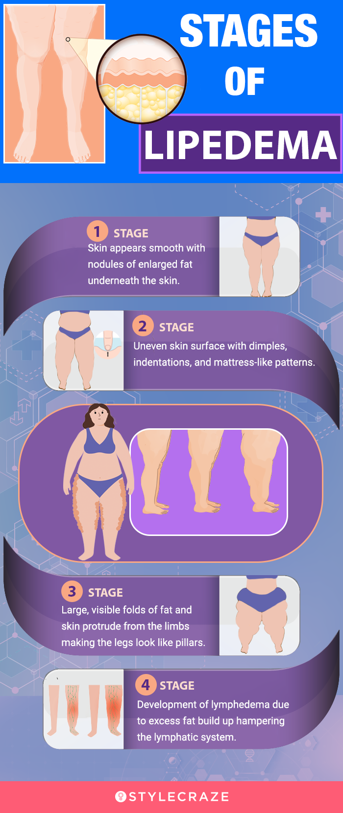 Lipedema Pinch Test: Do I Have Lipedema?