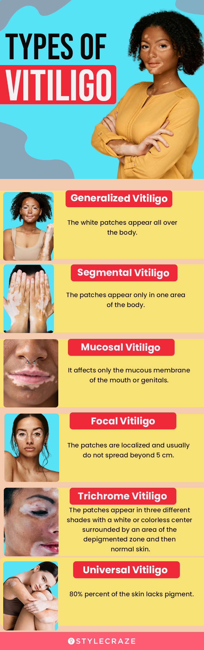 types of vitiligo [infographic]