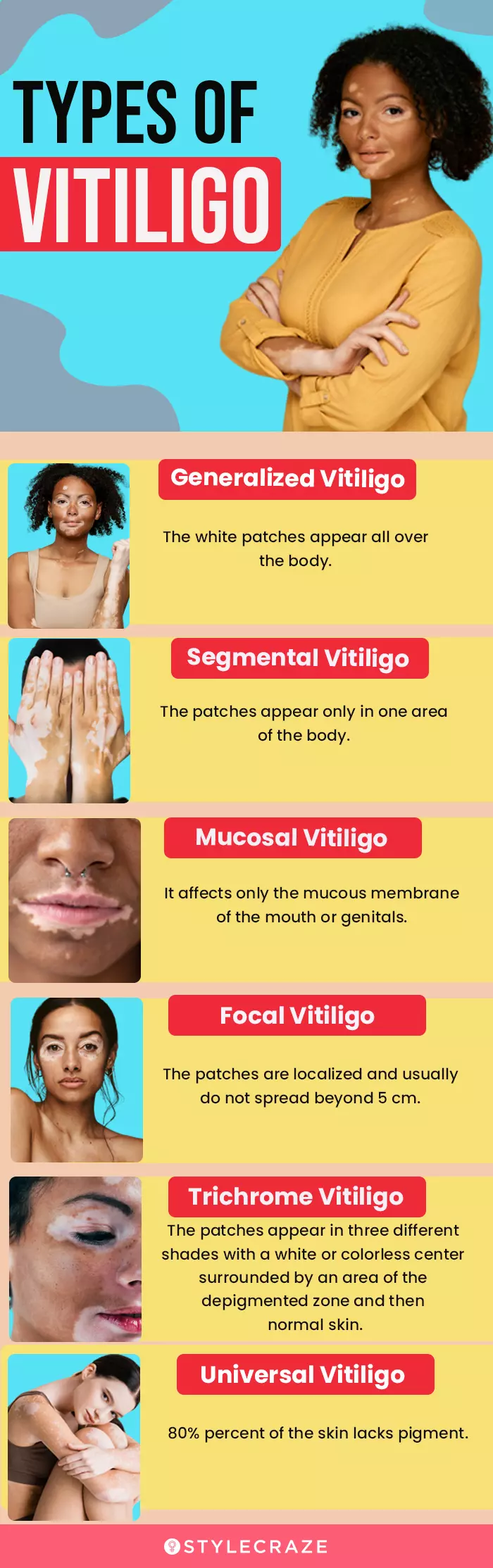 types of vitiligo (infographic)