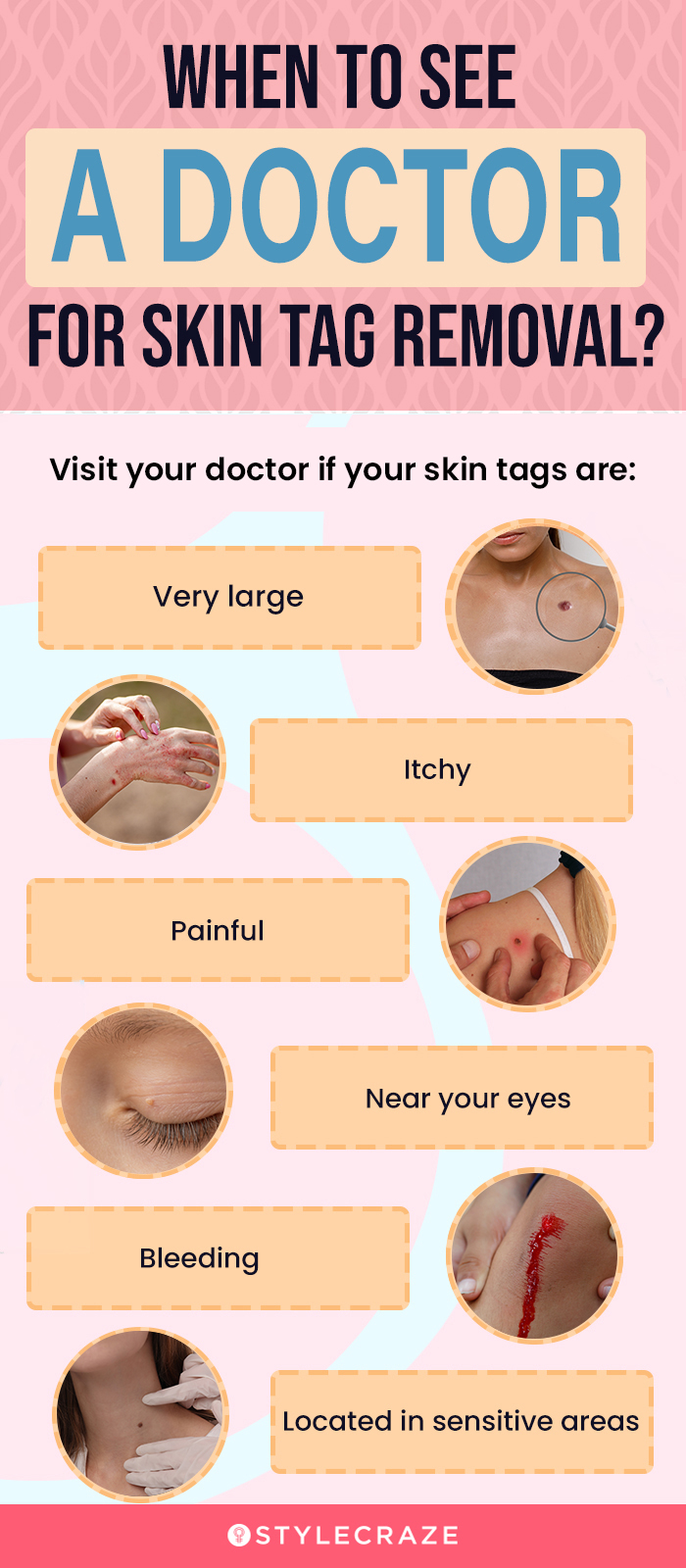 when to see a doctor for skin tag removal (infographic)