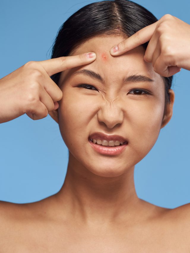 Why You Shouldn’t Burst Your Acne