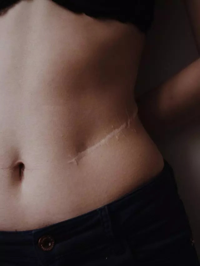 How To Remove Scars