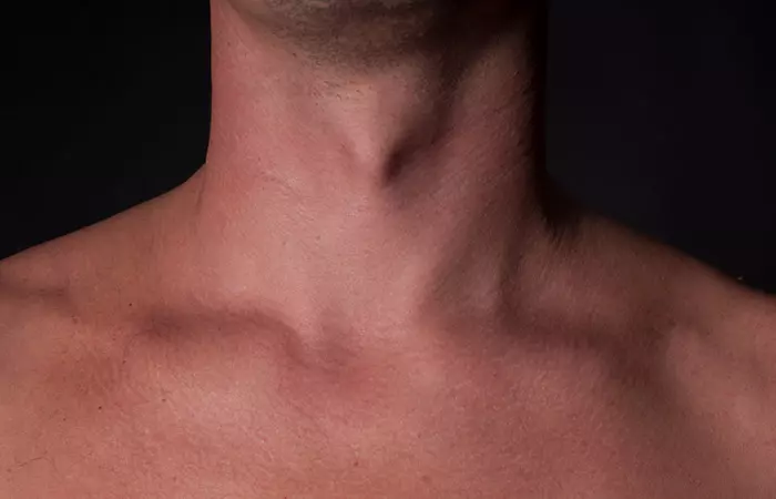 Adam's Apple