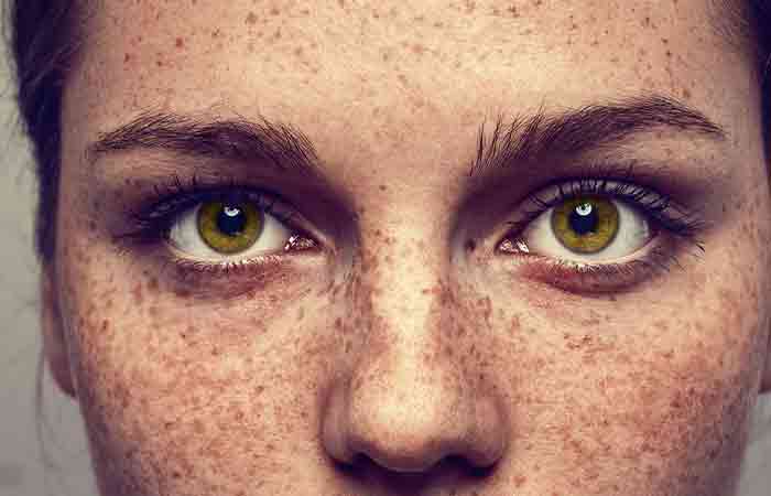 Getting-Rid-Of-Freckles