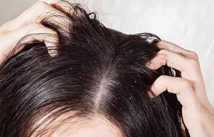 It-Might-Cause-More-Dandruff