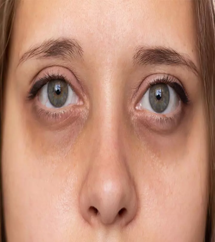 What Causes Dark Circles And How To Treat It_image