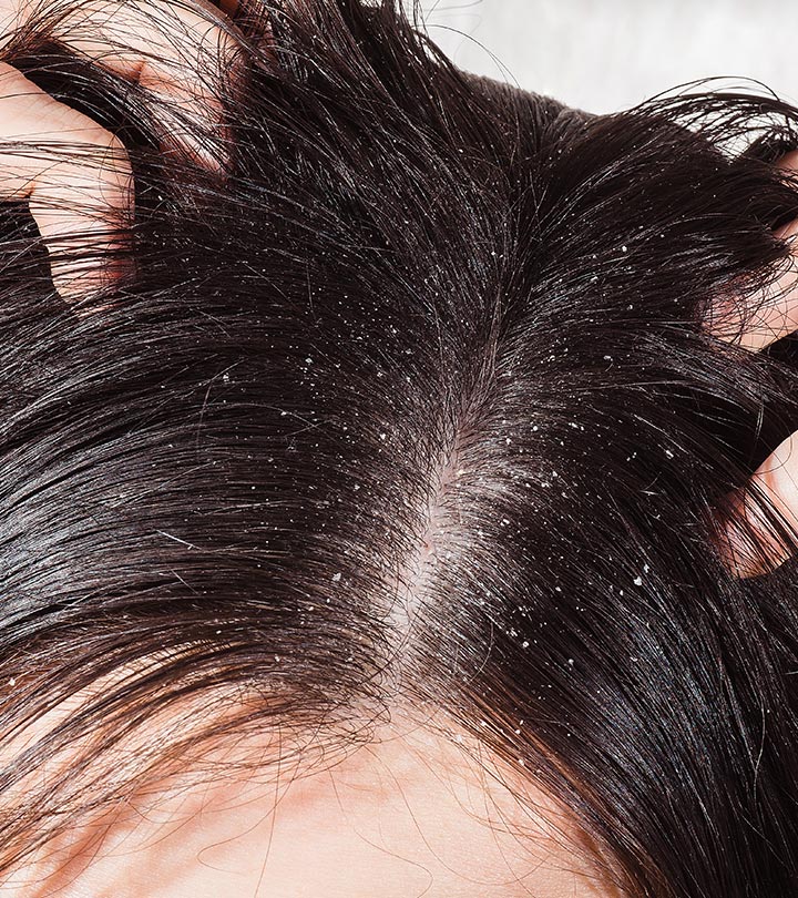 10 Ways To Stop Dandruff With Herbal Therapy