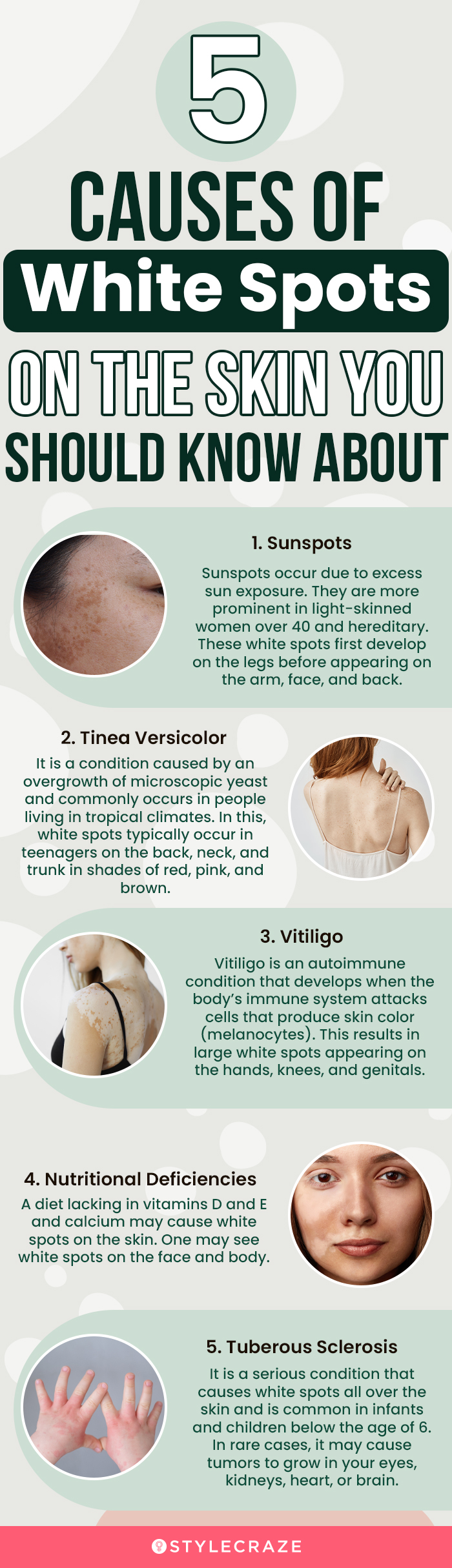 5 causes of white spots on skin you should know about (infographic)