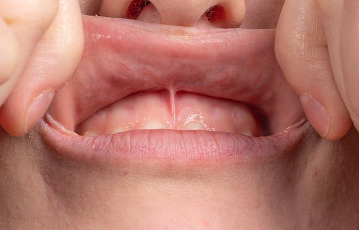 Frenulum