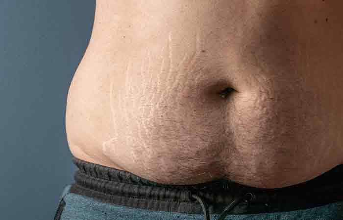 Stretch-Marks-Are-The-Result-Of-Weight-Gain