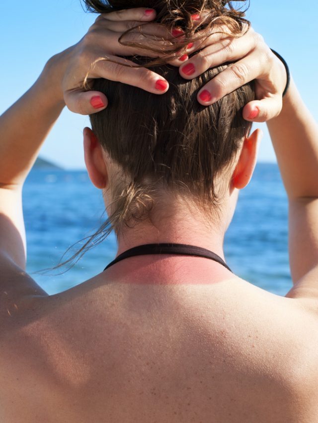 Experts Share How Sunburn Tanning Damage The Skin