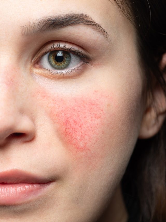 Difference Between Rosacea And Acne