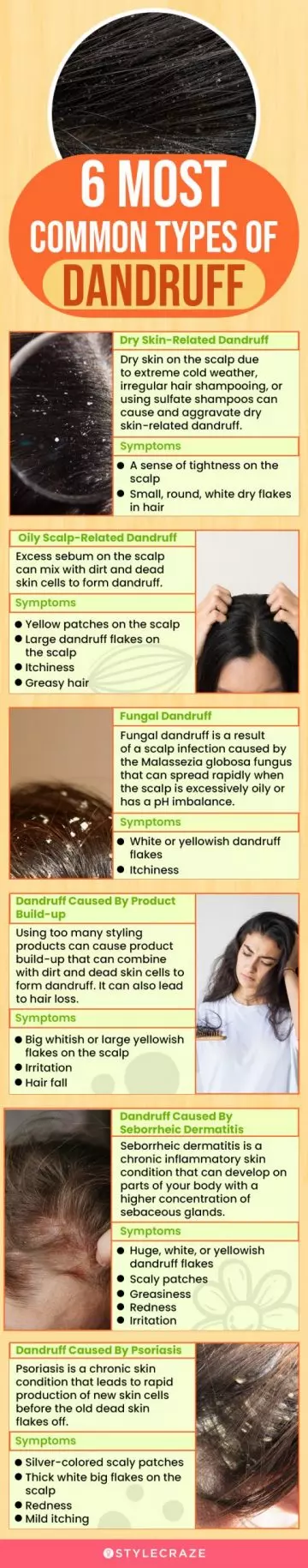 6 most common types of dandruff (infographic)