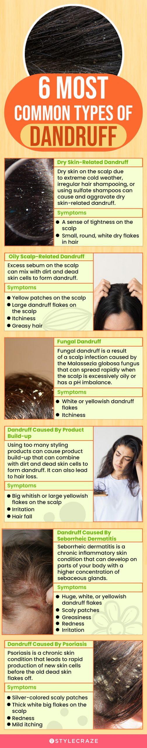 Different Types Of Dandruff And How To Stop Them 