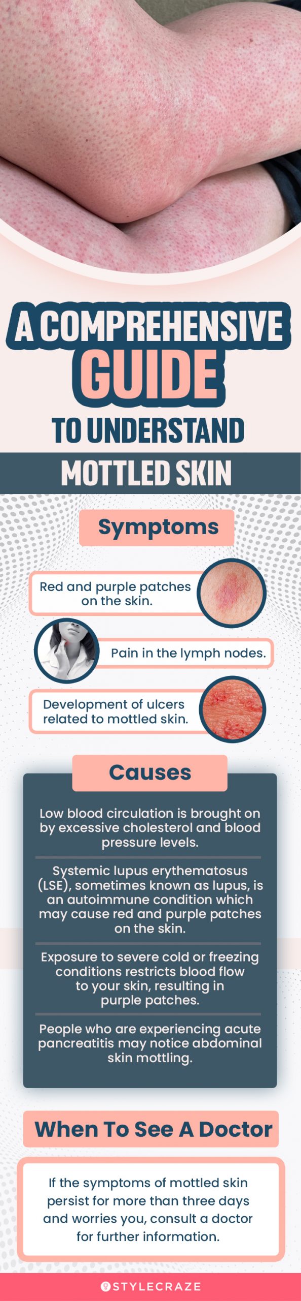 a comprehensive guide to understanding mottled skin (infographic)