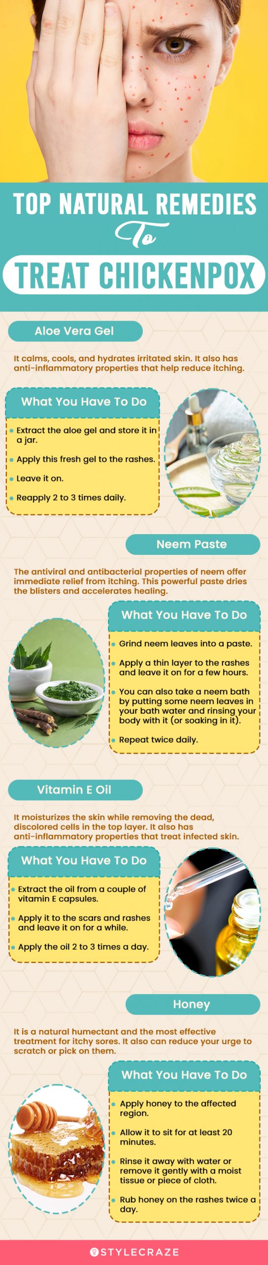 top natural remedies to treat chickenpox (infographic)