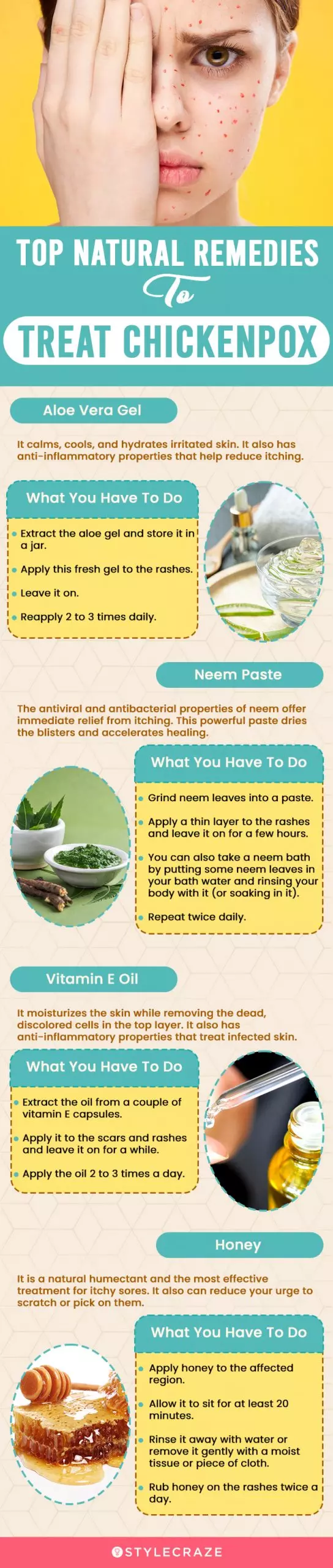 top natural remedies to treat chickenpox (infographic)
