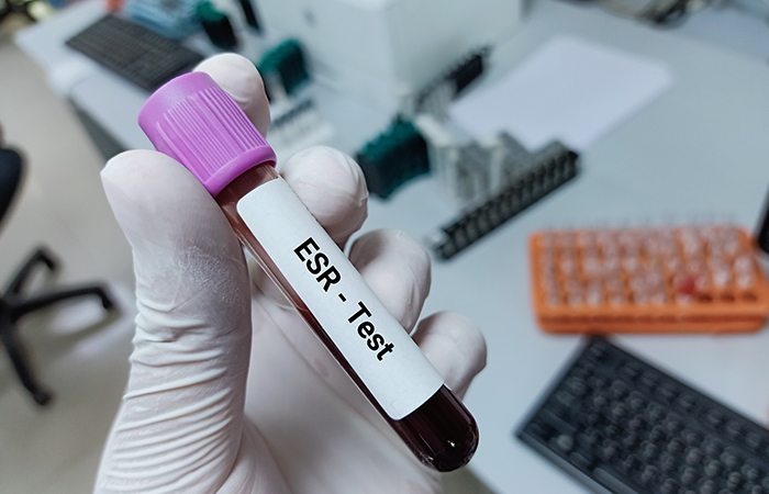 Blood sample for ESR test