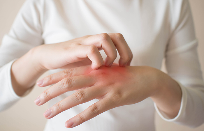 Close-up of a woman’s hand with psoriasis