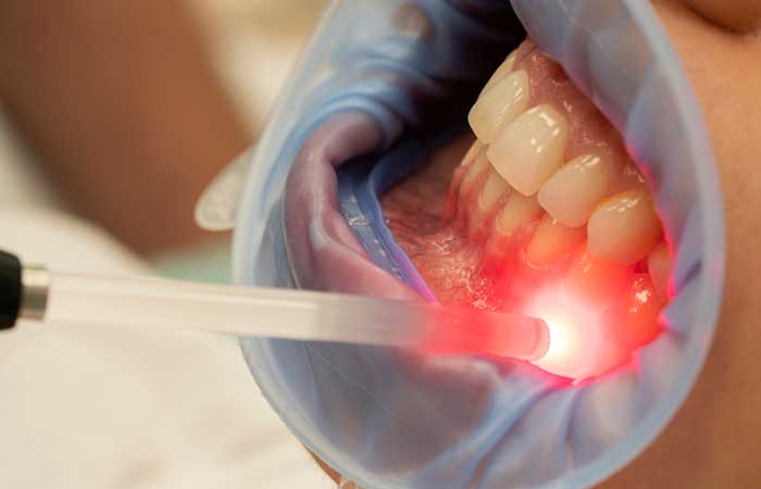 Doctor applying red light therapy for dental health