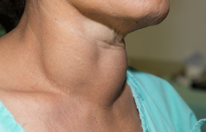 Woman with a goiter in Hashimoto’s thyroiditis