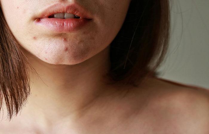 Chin-Strap