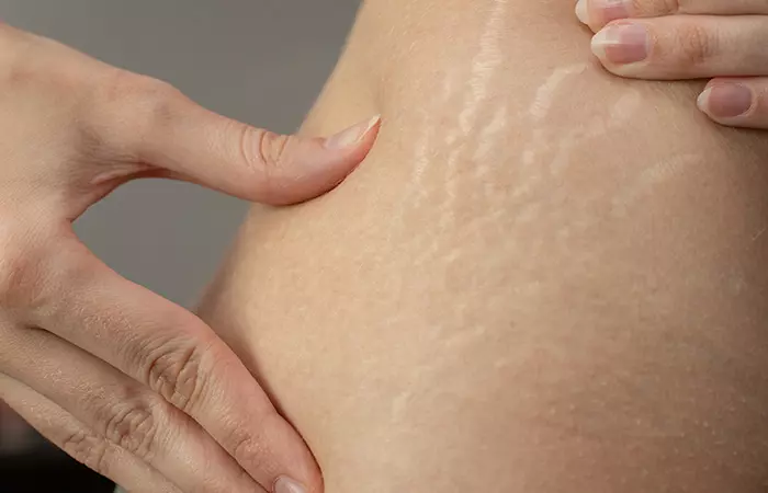 Hiding Stretch Marks