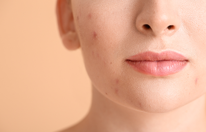 It May Be Used To Suppress Body Acne