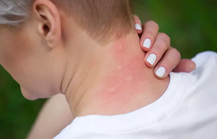It May Soothe Mosquito Bites