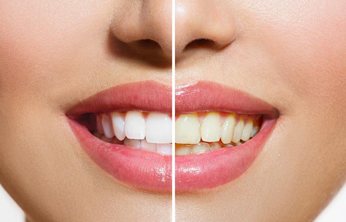 White Teeth Is A Sign Of Good Oral Health