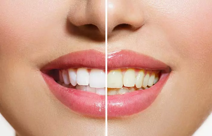 White Teeth Is A Sign Of Good Oral Health