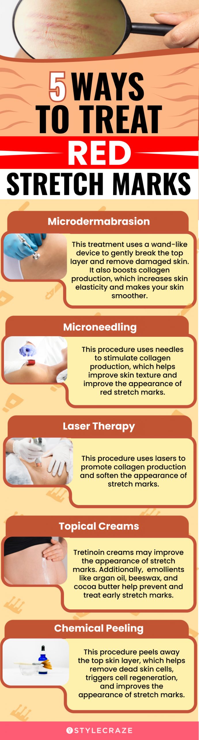 5 ways to treat red stretch marks (infographic)